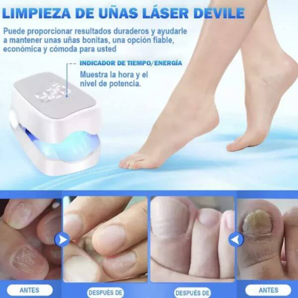 👣LÁSER PORTÁTIL ELIMINA ONICOMICOSIS EN 7 DÍAS 💫 - !LLEVATE 2X1 HOY!